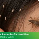 Natural Remedies for Head Lice