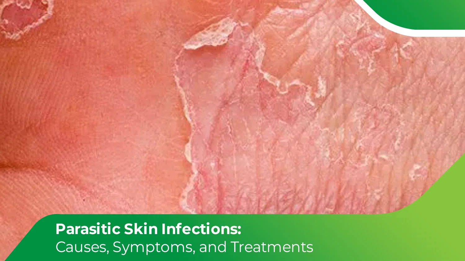 Parasitic Skin Infections: Causes, Symptoms, and Treatments