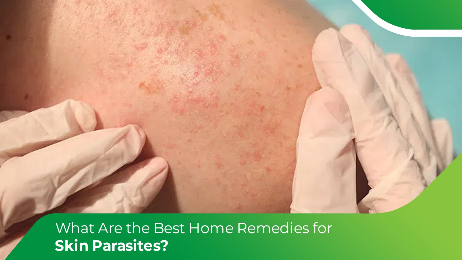 Close-up of skin rash caused by skin parasite infection being examined by gloved hands