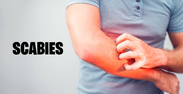 1 Scabies