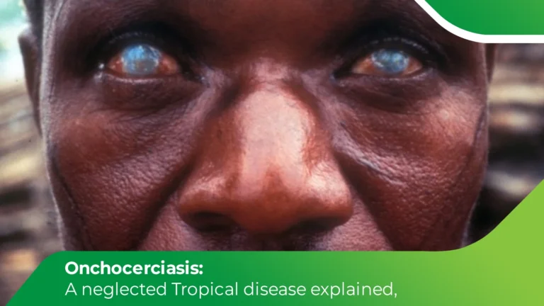 Close-up of eyes showing vision damage caused by onchocerciasis (river blindness)