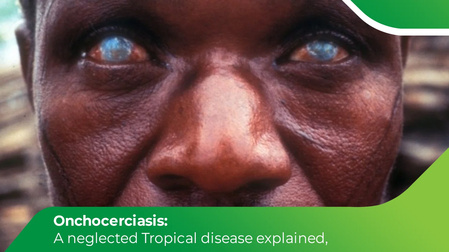 Close-up of eyes showing vision damage caused by onchocerciasis (river blindness)