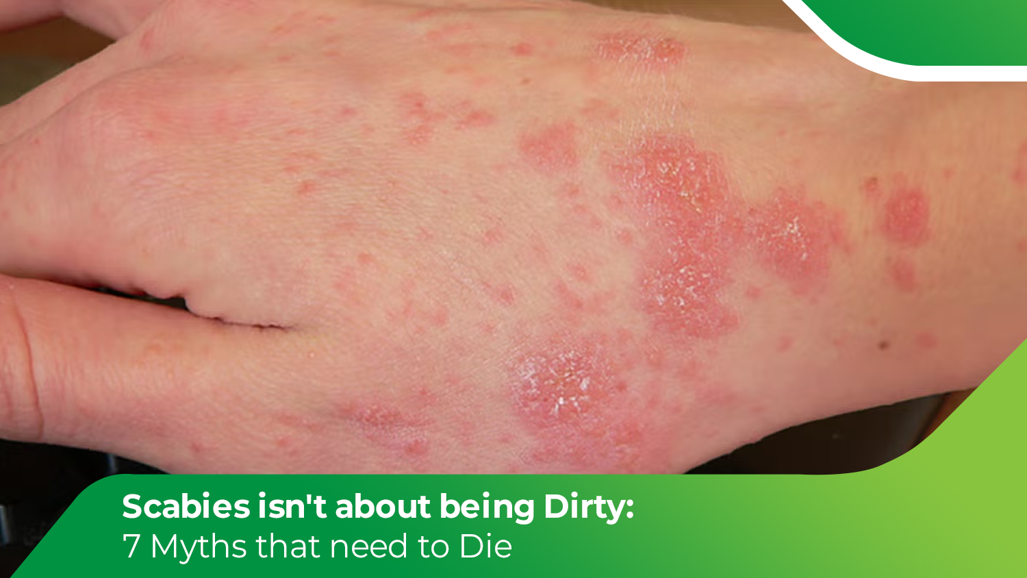 Scabies rash on skin showing redness and irritation