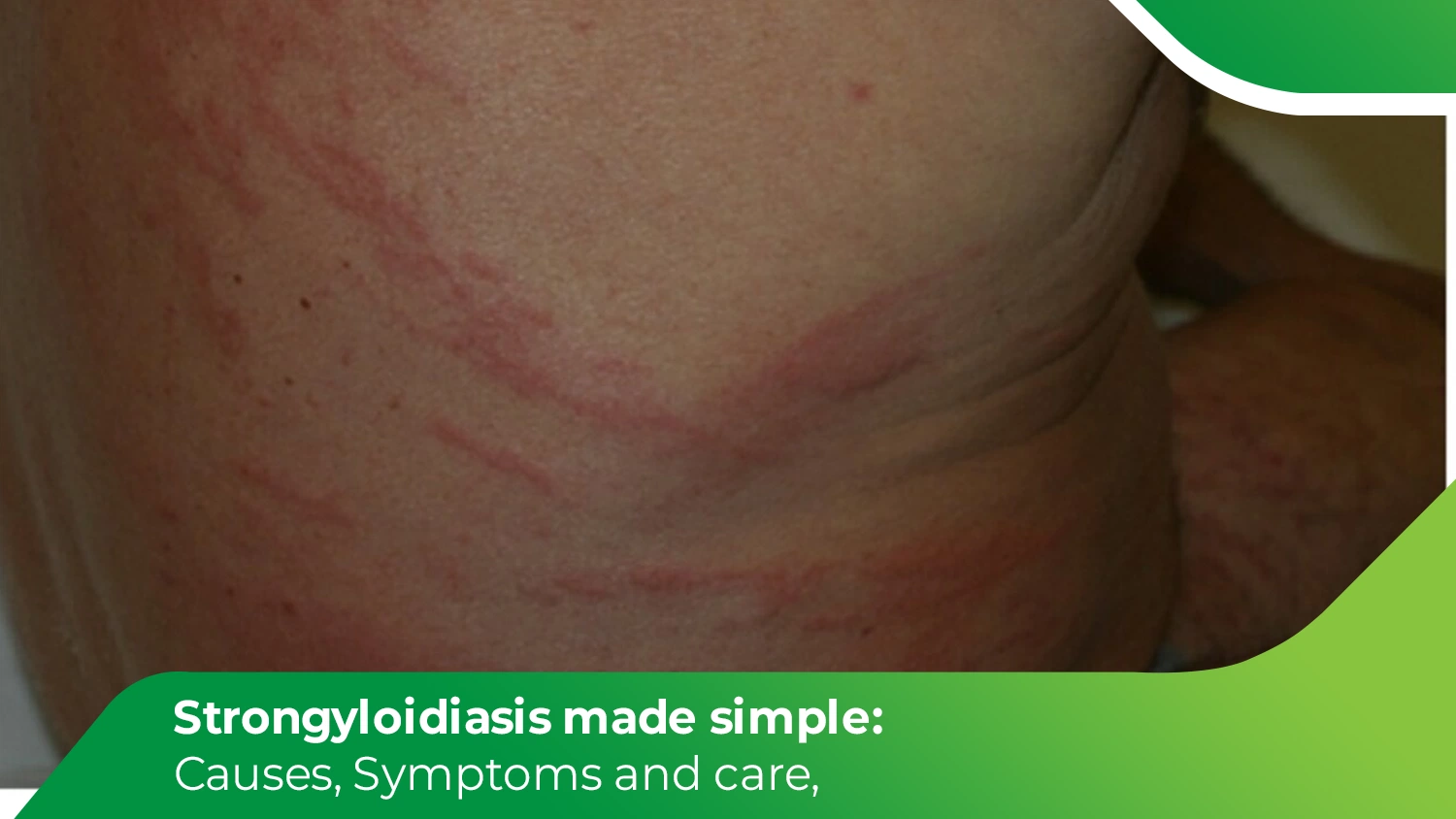 Strongyloidiasis skin rash showing larva currens with red, serpentine lines