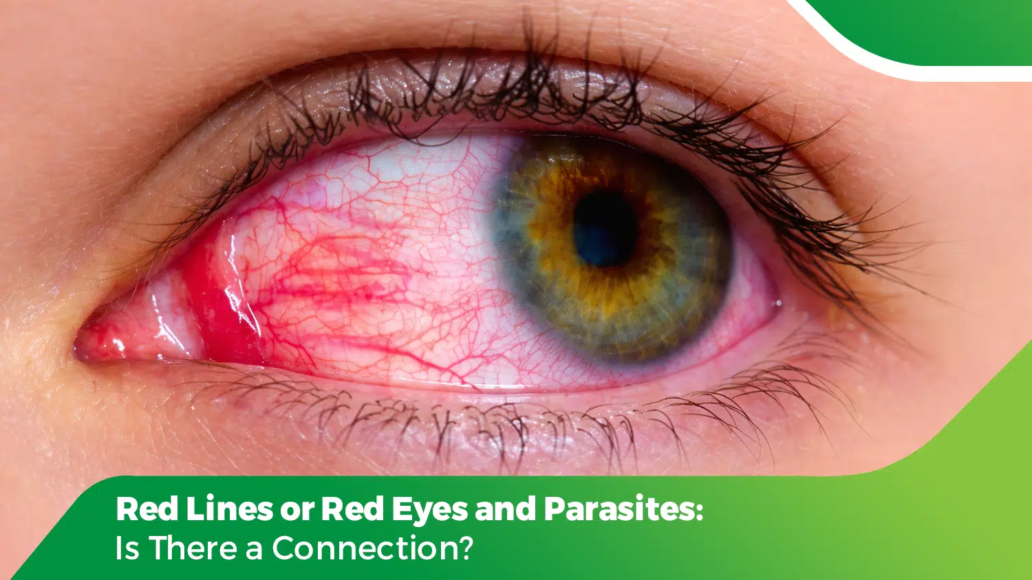 Close-up of a human eye showing red lines and red eyes with visible inflamed blood vessels, possibly linked to parasites.