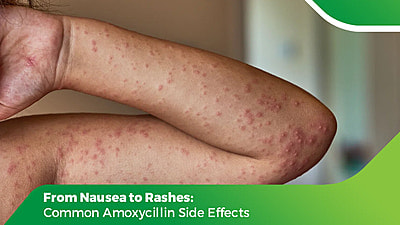 Skin rashes on the arm showing amoxycillin side effects after antibiotic use