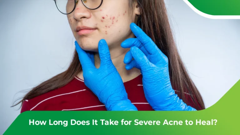 severe acne