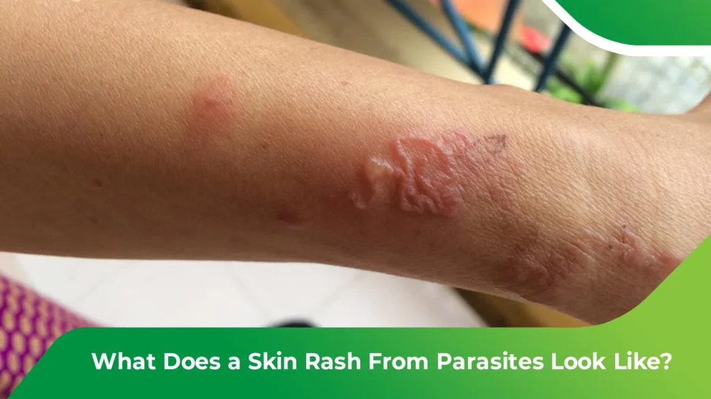 Skin rash from parasites showing red, irritated bumps and lesions on the arm.